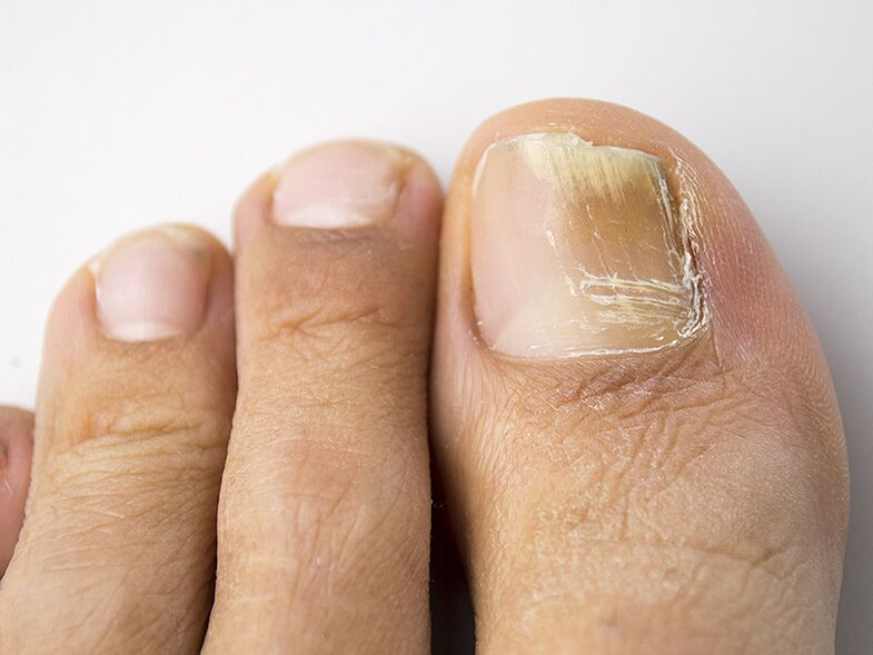 Sākotnējā sēnītes posms