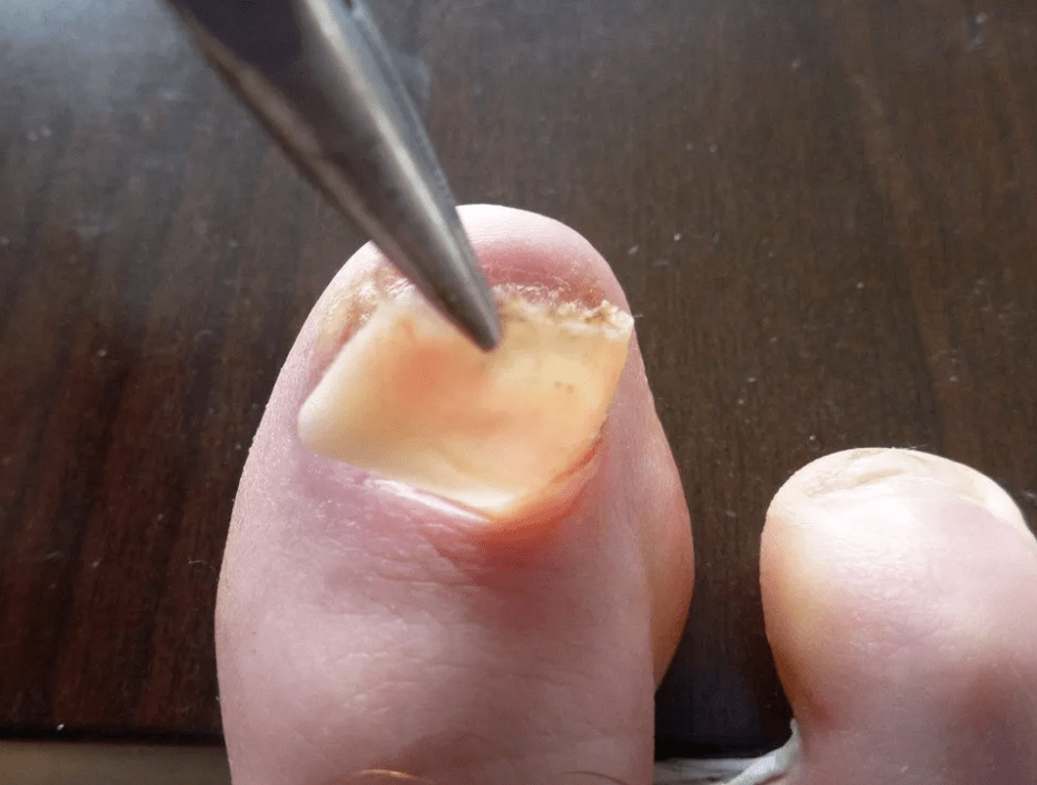 plāksnes noņemšana